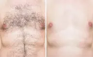 【男性】脇・胸・お腹・腕・脚・背中から1時間脱毛し放題