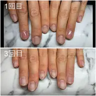 【深爪でお悩みの方おすすめ！】深爪矯正コース
