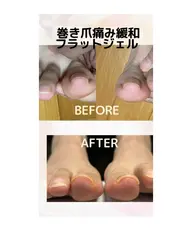 初回　巻き爪フラットジェル