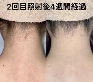 1か所脱毛(顔・髭・VIOは除く)