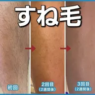 メンズ　両足脱毛　初回来店限定価格50%OFF