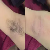 わき脱毛(ワックス+光)