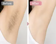脇脱毛