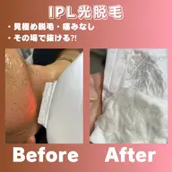 驚きの0円カウンセリング‼️追加料金無し。痛みのレベル確認に5回打ち★(お顔、腕、膝下のみ)