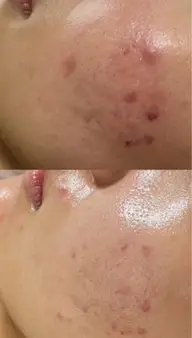 ✨人気No.2✨でき始めニキビケア🌿🫧