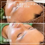 【初回】トリートメントフェイシャルWax xxx＋眉毛Wax脱毛付