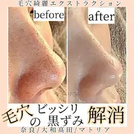 お悩みの毛穴を解決!毛穴エクストラクション