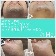 🍀メンズヒゲ脱毛1パーツ🥸🍀メンズのお顔の脱毛です✨しぶといヒゲを無くしていき剃刀負けの肌荒れもみるみる綺麗に💓