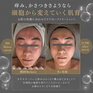 シミを薄く!白肌ツヤ肌幹細胞トリートメント
