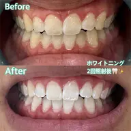 人気No.1⭐️【一度で高い効果】50分集中ホワイトニングお試し