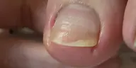 巻き爪ケア