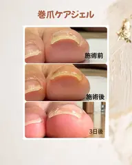 📣4月限定巻き爪ジェルモデル募集📣