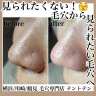 毛穴きれい!毛穴洗浄コース