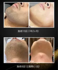 メンズ髭脱毛