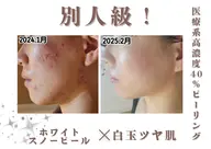 限定価格‼ホワイトスノーピール🐿🤍革命的な白さを追求!!!!!自慢のすっぴん肌で毛穴の黒ずみにも◎