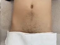 男性VIO【光脱毛】
