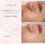 《発光ツヤ肌✨》セラピール+LDM水玉リフティング+プラズマニードル【 敏感肌・軽度のアトピーも施術可能◎】