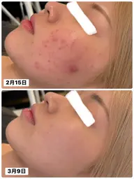 【モニターモデル募集💆♀️】シミシワ毛穴にきび等全ての肌悩みに効果あり❤️肌の細胞を若返らせ美しく✨臍帯リジェネ