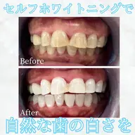 当日限定💡セルフホワイトニング【5980円→1880円】30分照射