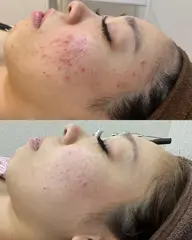平日限定！雪のような透明感【美白特化】シミくすみ徹底ケア✨揺らがない肌へ