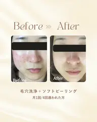 【ハイドラ毛穴洗浄】ニキビに悩んできる方へ🫧皮脂のつまりを取り除いて、ニキビができにくい肌へ✨️