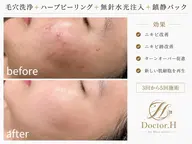 2名限定【ニキビケア・毛穴徹底ケア】1ヶ月集中肌管理〈週1ｘ４回〉