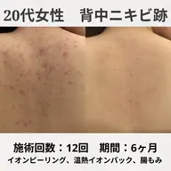 【平日限定クーポン❣️】 いつでも魅せれる肌に🥰ブライダルにも👰🏻♀️お背中集中ケア♩ピーリング+温熱ロウパック