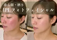 毛穴引締め、赤ら顔に光フェイシャル【通常9800円→5980円】