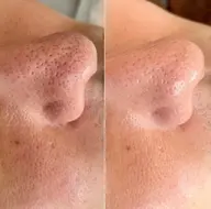 ✨人気No.1 ✨毛穴レス艶肌毛穴エクストラクション+ヒト幹細胞ポレーション+引き締め潤いパック+マッサージ