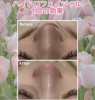 🎀U25限定🎀【ハイドロフェイシャル】毛穴洗浄+小顔ケア黒ずみ、毛穴、浮腫みに🛁🫧