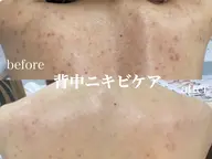 夏に向けて☀️背中　二の腕　お尻選べるハーブピーリング🌿22,000→8980