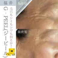 【初回限定】G-PEEL|60分|9/30まで新メニュー導入キャンペーン(期間終了後、価格変わります)