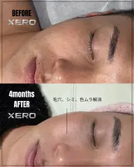 【モニター募集】ニキビ・毛穴など肌荒れに悩んでいるメンズへBEFORE AFTERの写真提供でお得に肌質改善🪄