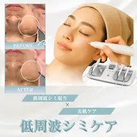 【本日31日1名様限定】20分間シミ取り放題💎優しい低周波で薄いシミ・濃いシミ・ニキビ跡1週間でポロッと剥離！