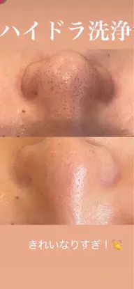 毛穴洗浄