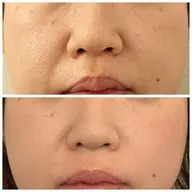 ハーブピーリング🌿剥離なし！毛穴、シミ、シワ・たるみなどエイジングケアに最適♪