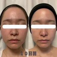 【頭・お顔整う】眠れるヘッドスパ（超高濃度ヒト幹細胞炭酸ガスパック付き）　肌荒れ、くすみ、赤みお悩みの方おすすめ