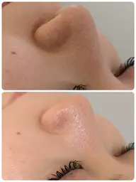 【毛穴ケア】毛穴洗浄フェイシャル🫧+パック+毛穴洗浄ヘッドorドライヘッドケア✨50分¥14,300