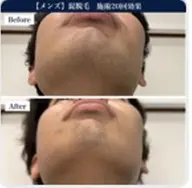 ＃枚方市メンズひげ脱毛　【メンズ限定】ヒゲ脱毛