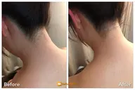 【脱毛】襟足の産毛、光脱毛で夏満喫♬（SHR、IPL、フラッシュ、光脱毛）