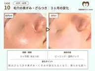 2回目以降【🌟大人ニキビケア・毛穴の🌟】角質除去60分 ¥15,000→¥12,100