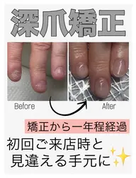 平日限定❤️🔥深爪矯正【長さ出し】◆カラーなし◆むしったり割れたり噛んで小さくなってしまった爪も美しく綺麗な状態に