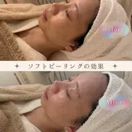 【毛穴悩み本気ケア】黒ずみ・角栓・ザラつき洗浄+ソフトピーリング✨