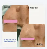 ＼特別な日の前日にはコレ／コラーゲン&ヒアルロン酸導入＋肩・首オイルマッサージ＋ヘッドスパ　80分