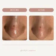 期間限定🎀💡夏のゴワつき、ベタつき解消🌻毛穴クリーニング◎剥けない毛穴ピーリング✖️モデリングマスク