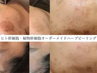 【毎日1名様限定◎】肌悩み別オーダーメイドハーブピーリング【剥離なし】天然国産ハーブ×ヒト幹細胞配合