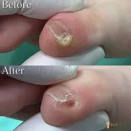 【副爪】口コミにご協力頂ける方限定⭐︎小指横の小さな爪…実はかた​〜​い角質😳綺麗に除去して痛みや違和感もスッキリ✨