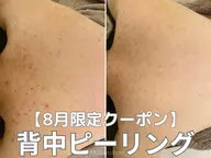 ☆8月限定☆背中ニキビケアピーリング+鎮静水分マスク 21300→15000