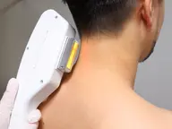 1番人気🔥 ヒゲ脱毛 初回500円 以降5000円