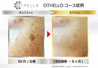 【シミが出来る根本にアプローチする次世代シミケアマシン】を使った練習モデル。メンズレディースどちらもOK!